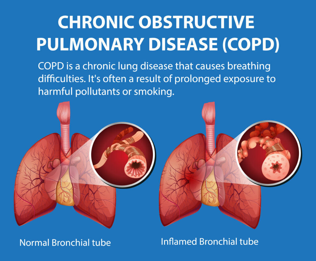 A Look at How COPD Affects the Lungs - West Tennessee Healthcare