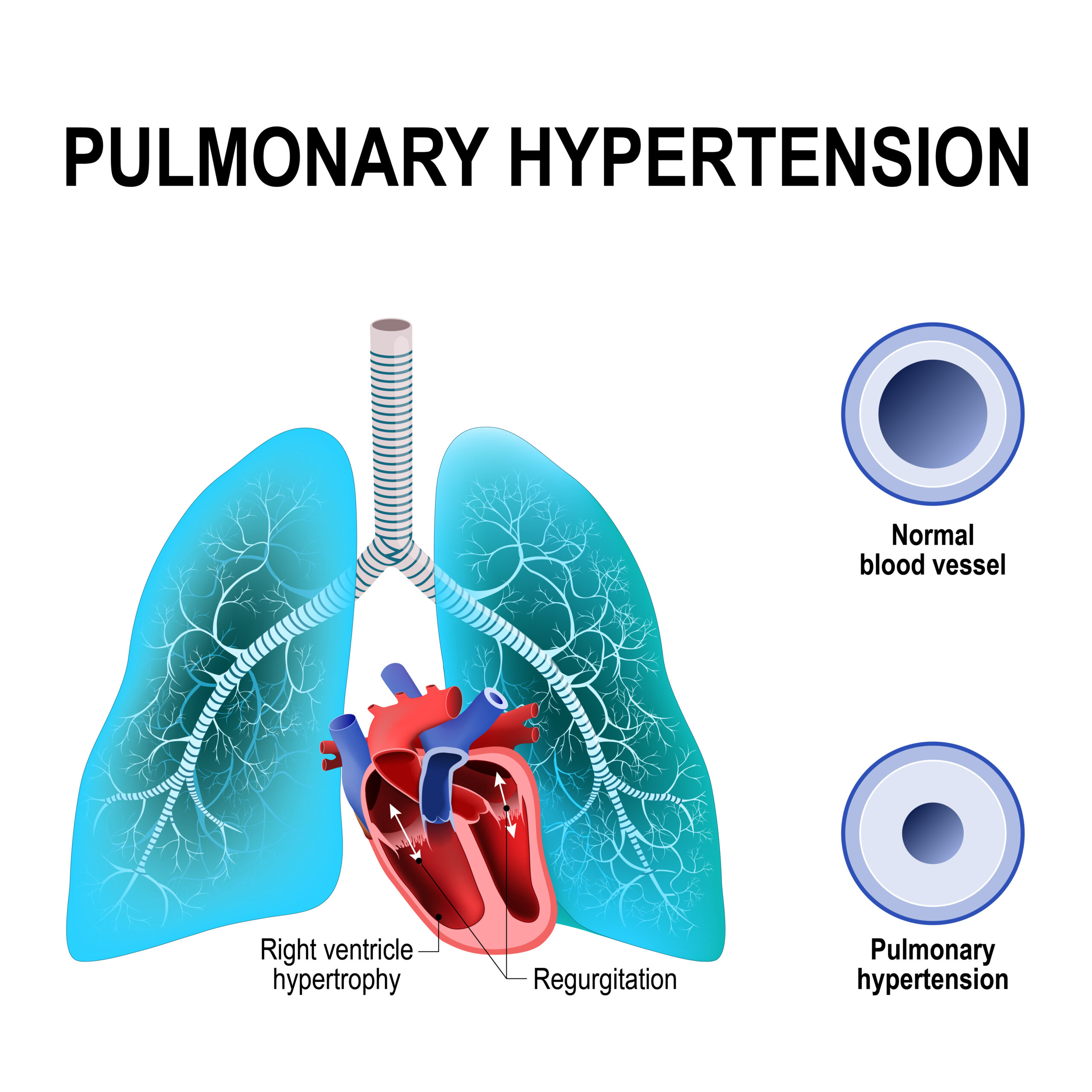 pulmonary hypertension diagram